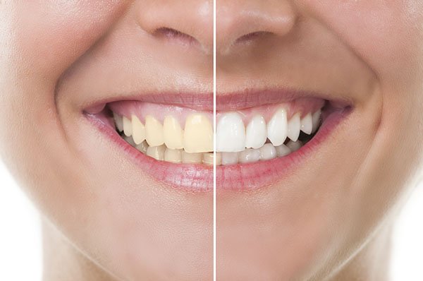 yellow teeth solutions in telugu
