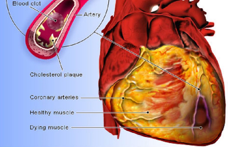 Precautions to be taken during heart stroke