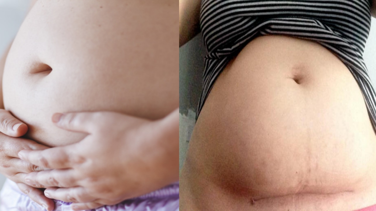 After c section belly