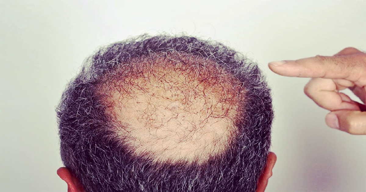 bald head 1