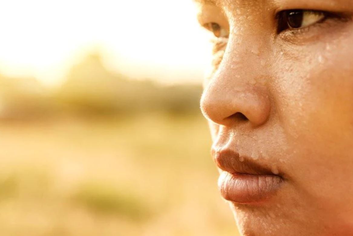 excessive sweating 1